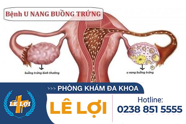 U Nang Buồng Trứng Là Gì? Triệu Chứng Và Cách Hỗ Trợ Điều Trị Hiệu Quả