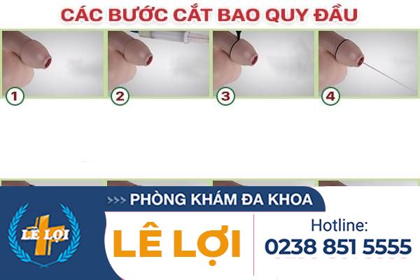 Đa Khoa Lê Lợi tiết lộ quy trình cắt bao quy đầu hiệu quả