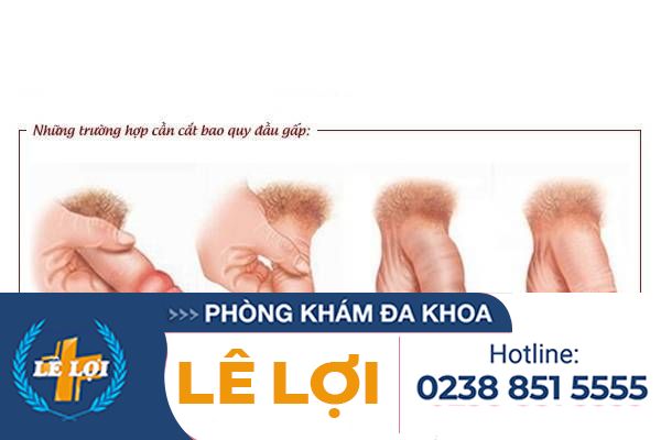 Những trường hợp cần cắt bao quy đầu gấp