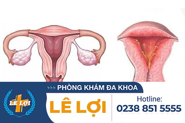 Những Tác Hại Của Bệnh Viêm Cổ Tử Cung Và Cách Điều Trị