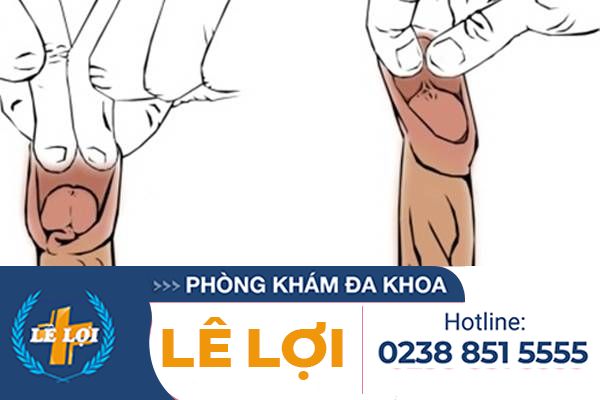 Thế nào là thừa bao quy đầu và có nên cắt bao quy đầu bị thừa không ?