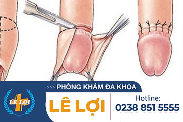 Phương pháp phẫu thuật cắt bao quy đầu không đau