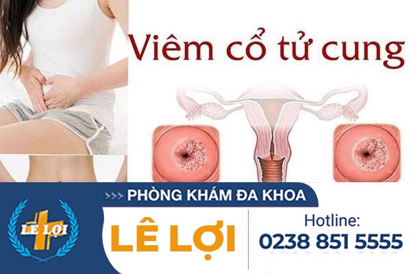 Viêm Cổ Tử Cung Và Cách Hỗ Trợ Chữa Trị Hiệu Quả