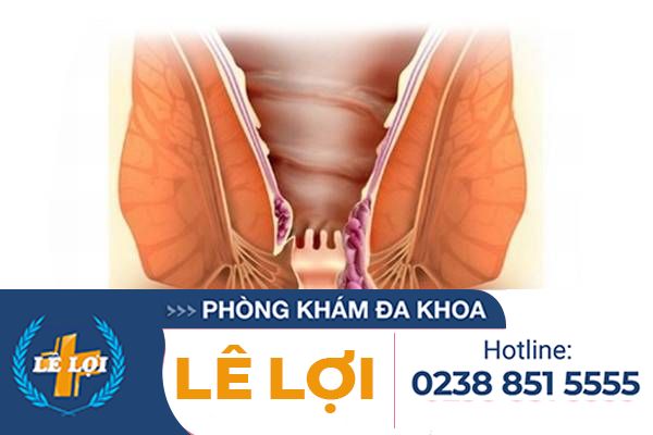 Triệu Chứng Bệnh Trĩ Ở Người Bệnh Dễ Nhận Biết