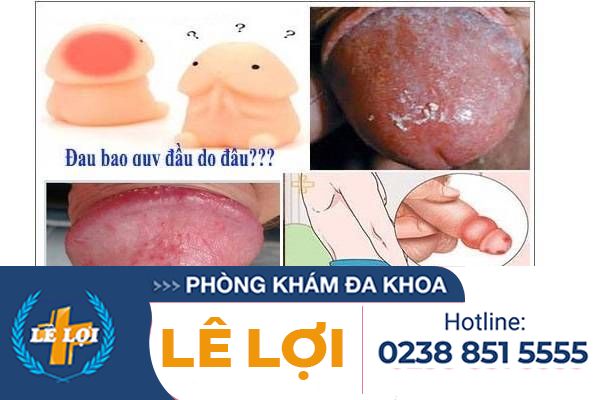 benh-nam-bao-quy-dau