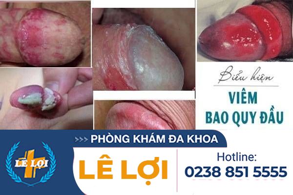 bieu-hien-viêm-bao-quy-đầu