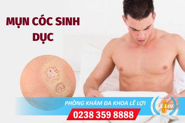 Mụn cóc sinh dục là bệnh gì ?