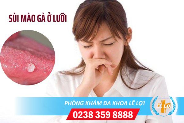 Thế nào là sùi mào gà ở lưỡi