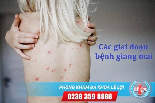 Giang mai có bao nhiêu giai đoạn?