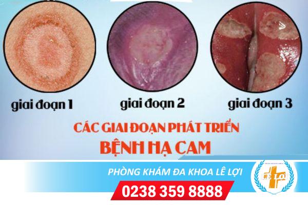 Bệnh hạ cam mềm và những điều cần biết