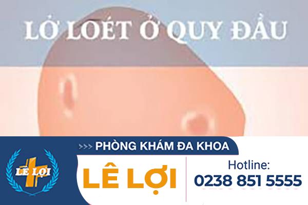 Loét bao quy đầu  báo hiệu bệnh lý nào ?