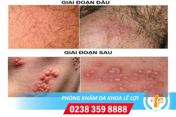 Bệnh mụn rộp sinh dục và những điều bạn cần biết