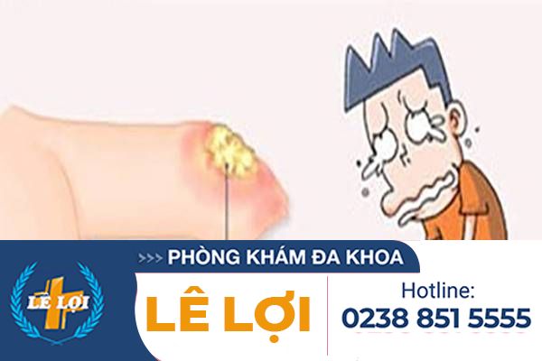 Ngứa bao quy đầu – đừng bao giờ bỏ qua