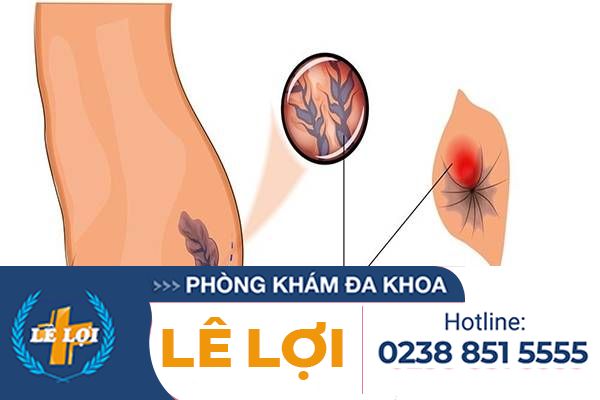 Nguyên nhân nào gây ngứa hậu môn ?