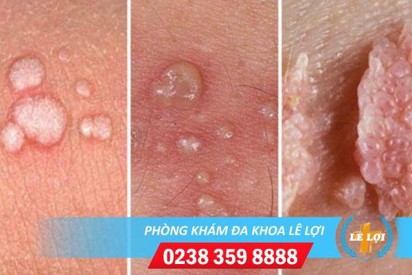 phuong-phap-dot-sui-mao-ga-hieu-qua-2