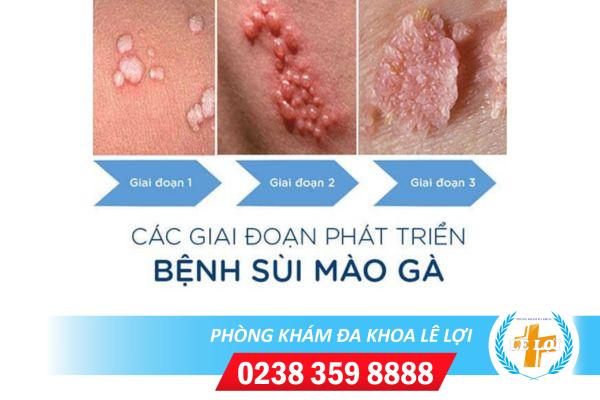 Bệnh sùi mào gà có chữa được không?
