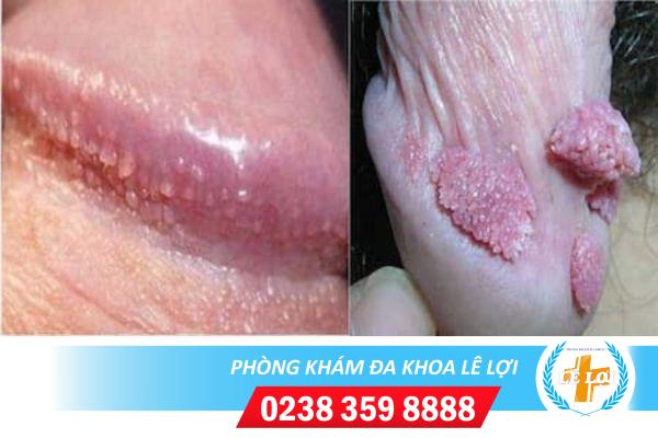 Bị vô sinh do mắc sùi mào gà ở dương vật