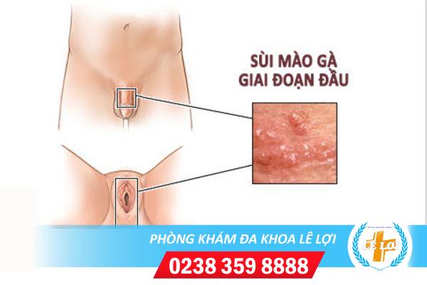 Sùi mào gà giai đoạn đầu như thế nào?