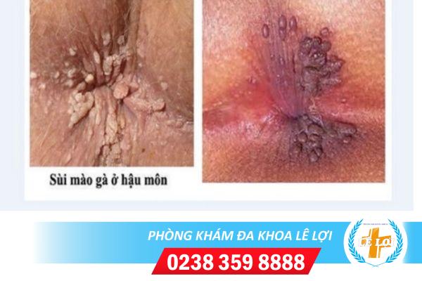 Bệnh sùi mào gà ở hậu môn