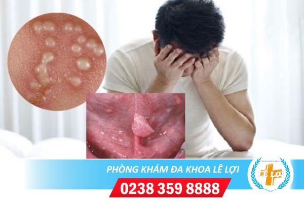 Bệnh sùi mào gà ở nam giới và cách hỗ trợ chữa trị hiệu quả