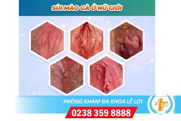 Bệnh sùi mào gà ở nữ và những điều cần biết