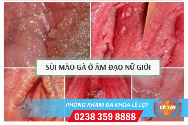 Sùi Mào Gà Ở Âm Đạo Nguy Hiểm Như Thế Nào ?
