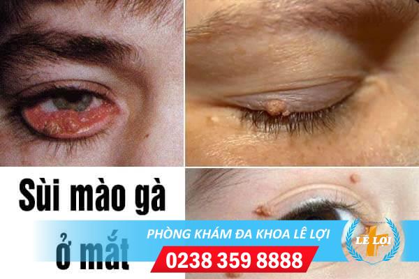 Bệnh sùi mào gà ở mắt