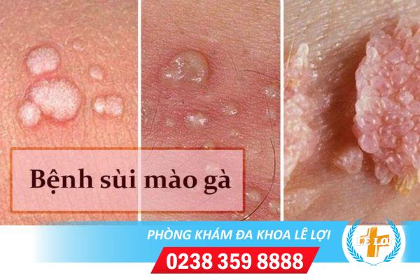 Biểu hiện của bệnh sùi mào gà
