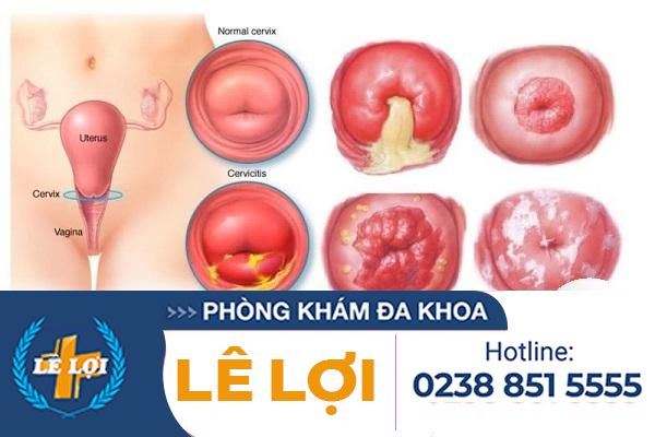 tac-hai-viem-lo-tuyen-co-tu-cung