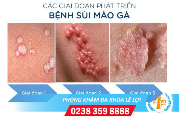 thoi-gian-phat-benh-sui-mao-ga-la-bao-lau-1