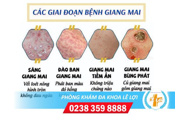 Triệu chứng bệnh giang mai qua từng giai đoạn