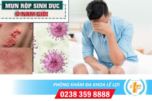 Triệu chứng của bệnh mụn rộp sinh dục ở nam