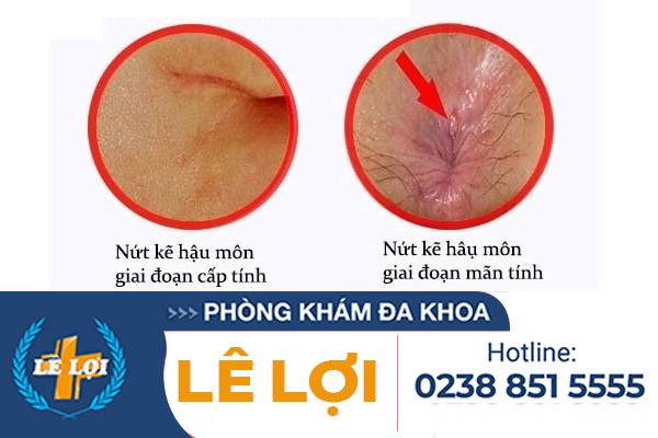 trieu-chung-nut-ke-hau-mon