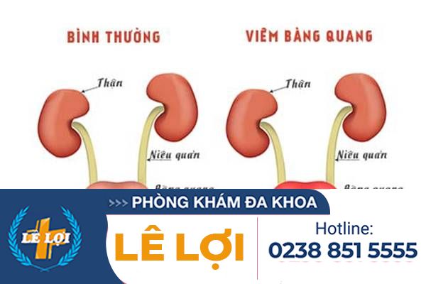 Triệu chứng của bệnh viêm bàng quang