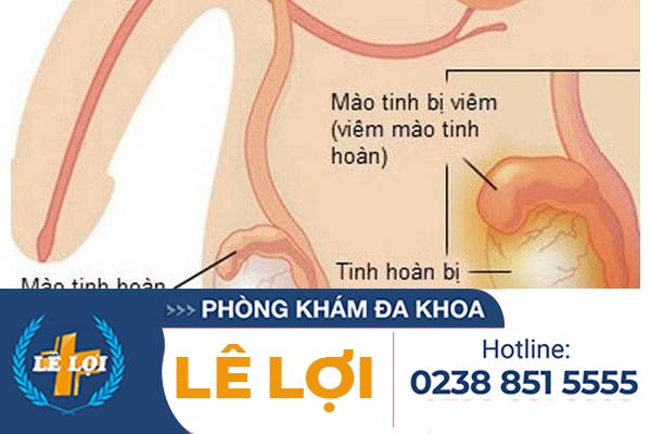 Tìm hiểu về bệnh viêm mào tinh hoàn