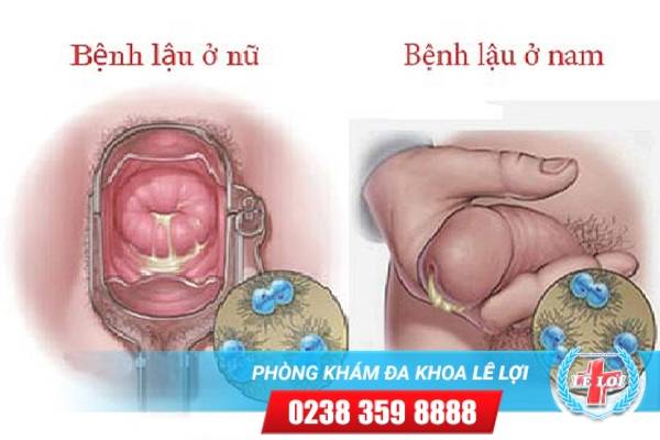 Các triệu chứng bệnh lậu dễ nhận biết nhất