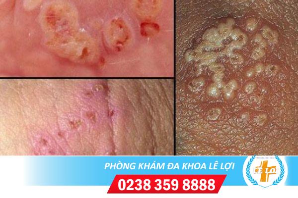 Biểu hiện của bệnh lậu ra sao?