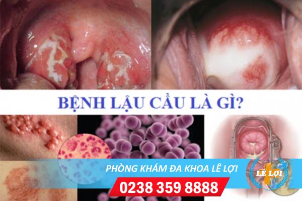 benh-lau