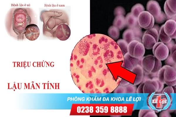 Bệnh lậu mãn tính và phương pháp hỗ trợ điều trị