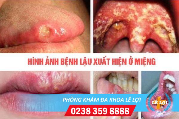 phuong-phap-ho-tro-dieu-tri-benh-lau-o-mieng-2