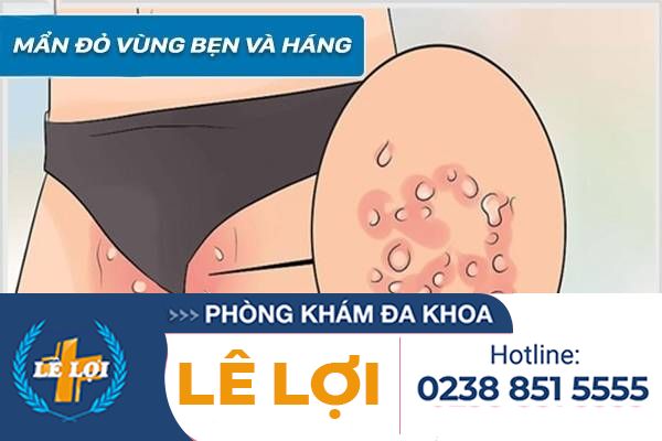 Mẩn đỏ vùng bẹn và háng xử lí như thế nào ?