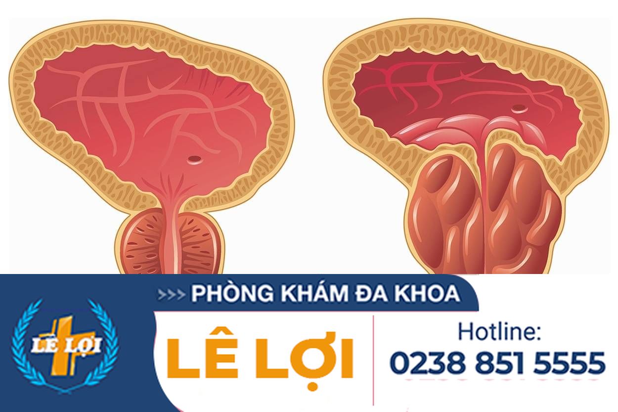 Phì đại tuyến tiền liệt là như thế nào ?