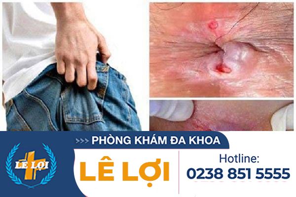 noi-mun-o-hau-mon-la-bieu-hien-cua-benh-gi-2