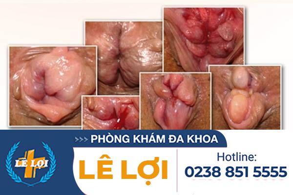 Benh-loi-dom-la-gi-nguyen-nhan-trieu-chung-va-cach-dieu-tri