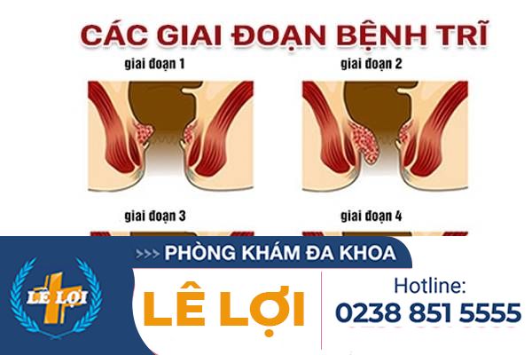 Các giai đoạn bệnh trĩ và cách điều trị