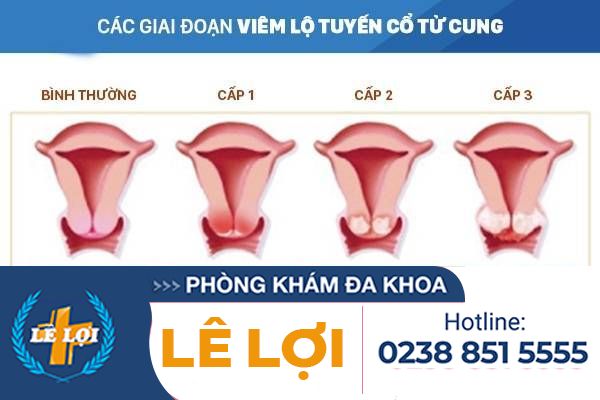 Các giai đoạn viêm lộ tuyến cổ tử cung