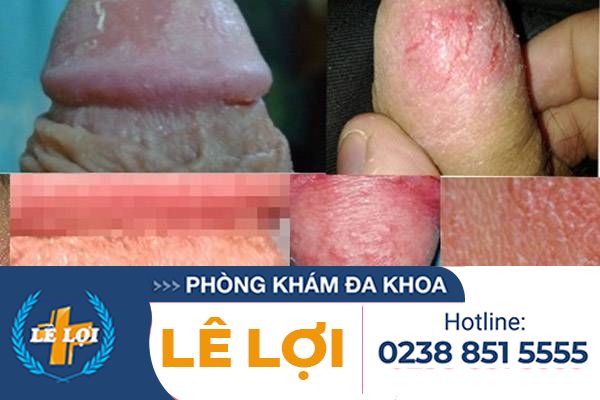 da-bao-quy-dau-bi-ran-nut-1