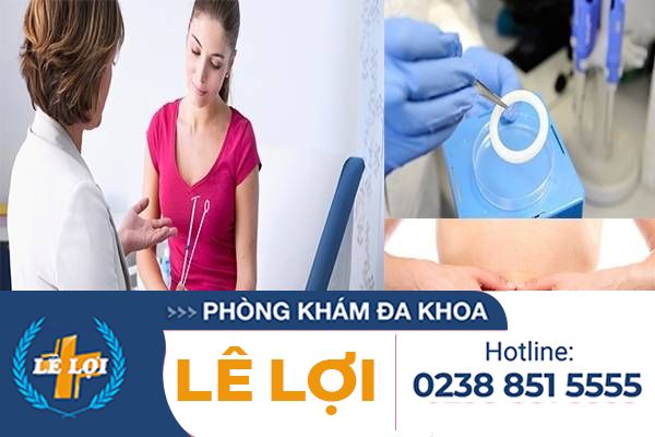 Đặt vòng tránh thai và những điều cần lưu ý