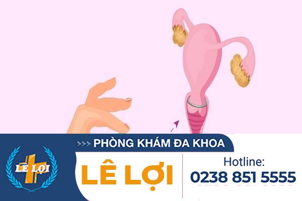 Đặt vòng tránh thai và những điều cần lưu ý