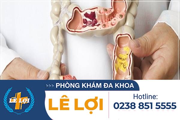 Những bệnh hậu môn trực tràng thường gặp